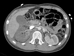 Renal Infarction S/P Trauma - CTisus CT Scan
