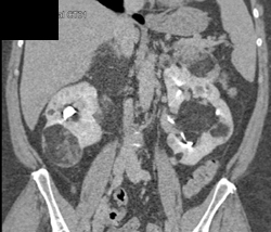 Renal Angiomyolipomas (AMLs) - CTisus CT Scan