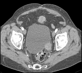 Bladder Cancer - CTisus CT Scan
