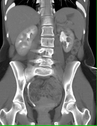 Bladder Cancer - CTisus CT Scan