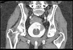 Bladder Cancer - CTisus CT Scan