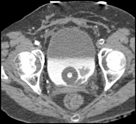 Bladder Cancer - CTisus CT Scan