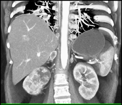 Renal Cell Carcinoma - CTisus CT Scan