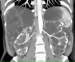 Pckd and Pcld - CTisus CT Scan