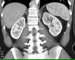 Acute Pyelonephritis - CTisus CT Scan