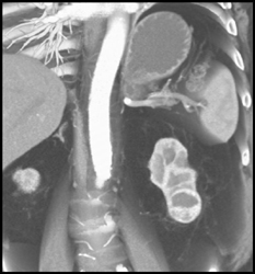 Renal Cell Carcinoma - CTisus CT Scan