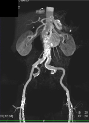 Renal Artery Aneurysm - CTisus CT Scan