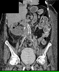 Renal Abscess - CTisus CT Scan