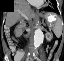 Renal Artery Aneurysm - CTisus CT Scan