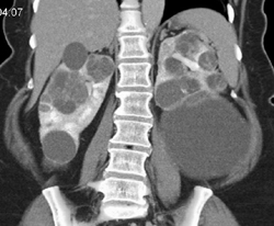Complex Cysts With Right Renal Cell Carcinoma (RCC) in Cyst - CTisus CT Scan