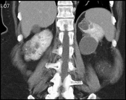 Cystic Renal Cell Carcinoma (RCC) - CTisus CT Scan