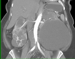 Renal Cell ?? No Vessel - CTisus CT Scan