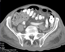 Bladder Cancer - CTisus CT Scan