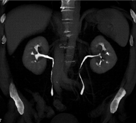Transitional Cell Carcinoma of the Left Kidney - CTisus CT Scan