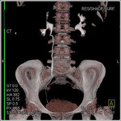 Normal CT Urogram - CTisus CT Scan