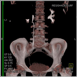 Normal CT Urogram - CTisus CT Scan