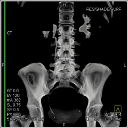 Normal CT Urogram - CTisus CT Scan