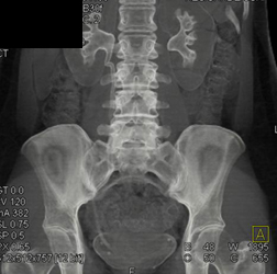 Normal CT Urogram - CTisus CT Scan