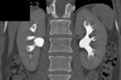 Normal CT Urogram - CTisus CT Scan