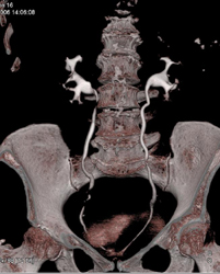 Normal CT Urogram - CTisus CT Scan