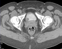 Bladder Cancer - CTisus CT Scan