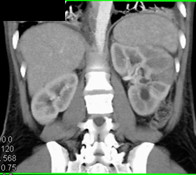 Acute Pyelonephritis - CTisus CT Scan