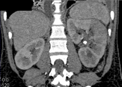 Acute Pyelonephritis - CTisus CT Scan