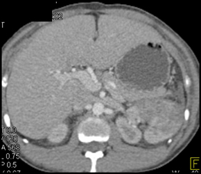 Acute Pyelonephritis - CTisus CT Scan