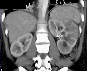 Acute Pyelonephritis - CTisus CT Scan