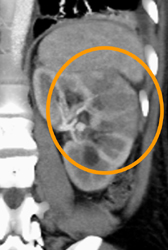 Acute Pyelonephritis - CTisus CT Scan