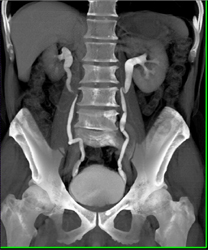 Normal CT Urogram - CTisus CT Scan