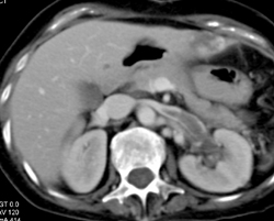 Normal CT Urogram - CTisus CT Scan