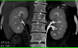Papillitis Due to Infection - CTisus CT Scan