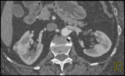 Renal Cell Carcinoma - CTisus CT Scan