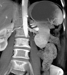 Left Renal Artery Aneurysm - CTisus CT Scan