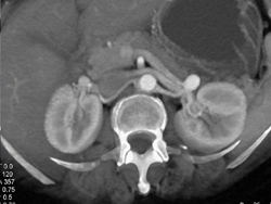 Left Renal Artery Aneurysm - CTisus CT Scan
