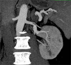 Prehilar Branching of the Left Kidney - CTisus CT Scan