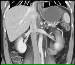 Pretty Left Adrenal Vein - CTisus CT Scan