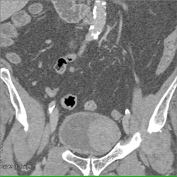 Bladder Cancer - CTisus CT Scan