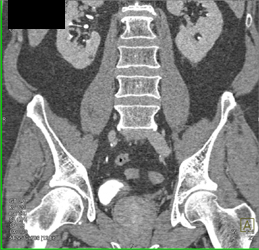 Bladder Cancer - CTisus CT Scan