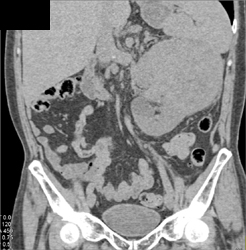 Renal Cell Carcinoma - CTisus CT Scan