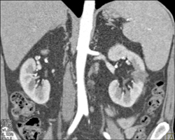 Acute Pyelonephritis - CTisus CT Scan