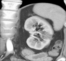 Acute Pyelonephritis - CTisus CT Scan