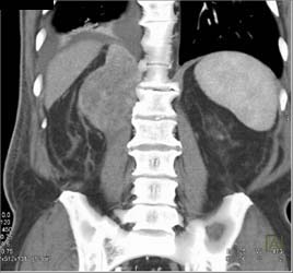 Neurogenic Tumor Near Kidney - CTisus CT Scan