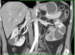 Renal Cell Carcinoma - CTisus CT Scan
