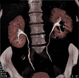 Renal Cell Carcinoma - CTisus CT Scan