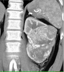 Hypervascular Renal Cell Carcinoma - CTisus CT Scan
