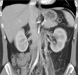 Chronic Renal Vein Thrombosis (RVT) With Periureteral Collaterals - CTisus CT Scan