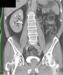 Ectopic Ureterocele Simulates A Bladder Cancer - CTisus CT Scan