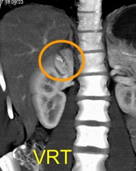 Renal Laceration - CTisus CT Scan